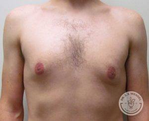 Breast Reduction in Nashville