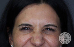 close-up of brunette woman's forehead after botox